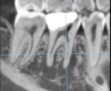 マイクロスコープ下での根管の様子