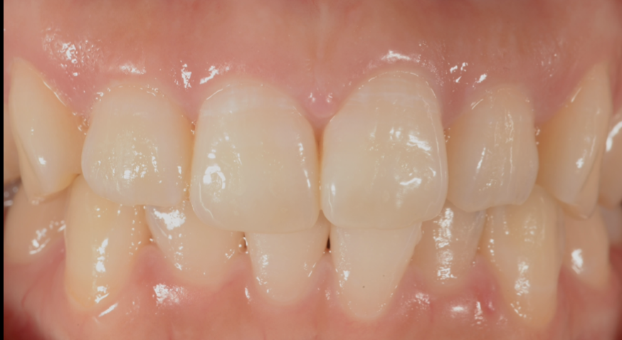 歯を白くしたい