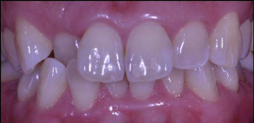 前歯が中に入っている