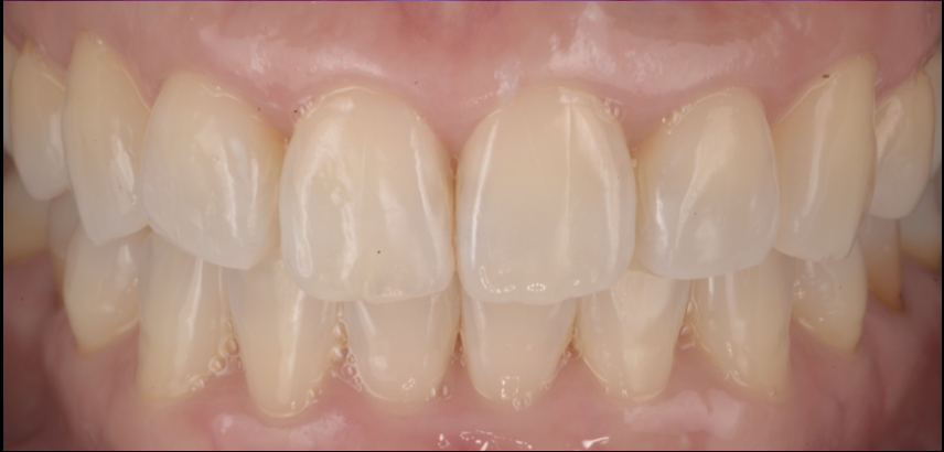 前歯が中に入っている