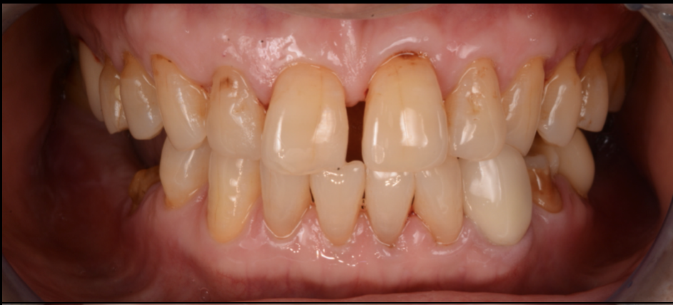 ブリッジが壊れた