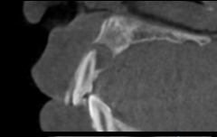 多発性歯根嚢胞を精密根管治療、歯根端切除術を行なった症例