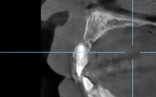 多発性歯根嚢胞を精密根管治療、歯根端切除術を行なった症例