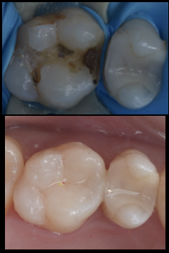 銀歯が外れて歯が沁みる