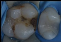 銀歯が外れて歯が沁みる