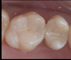 銀歯が外れて歯が沁みる
