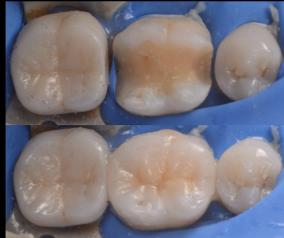 他院で入れたセラミックが虫歯になっている