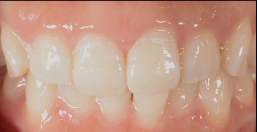 歯を白くしたい