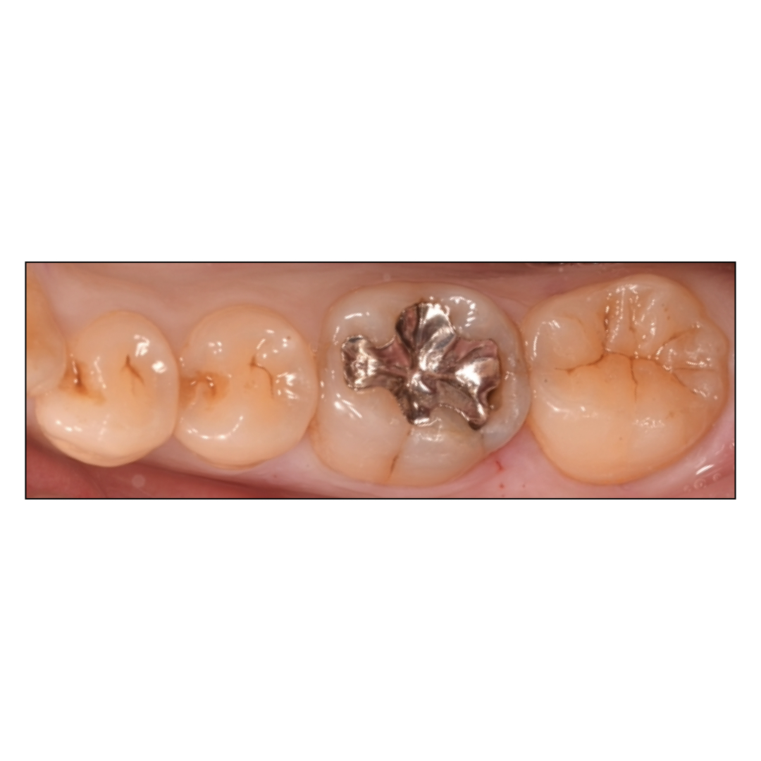 ダイレクトボンディング