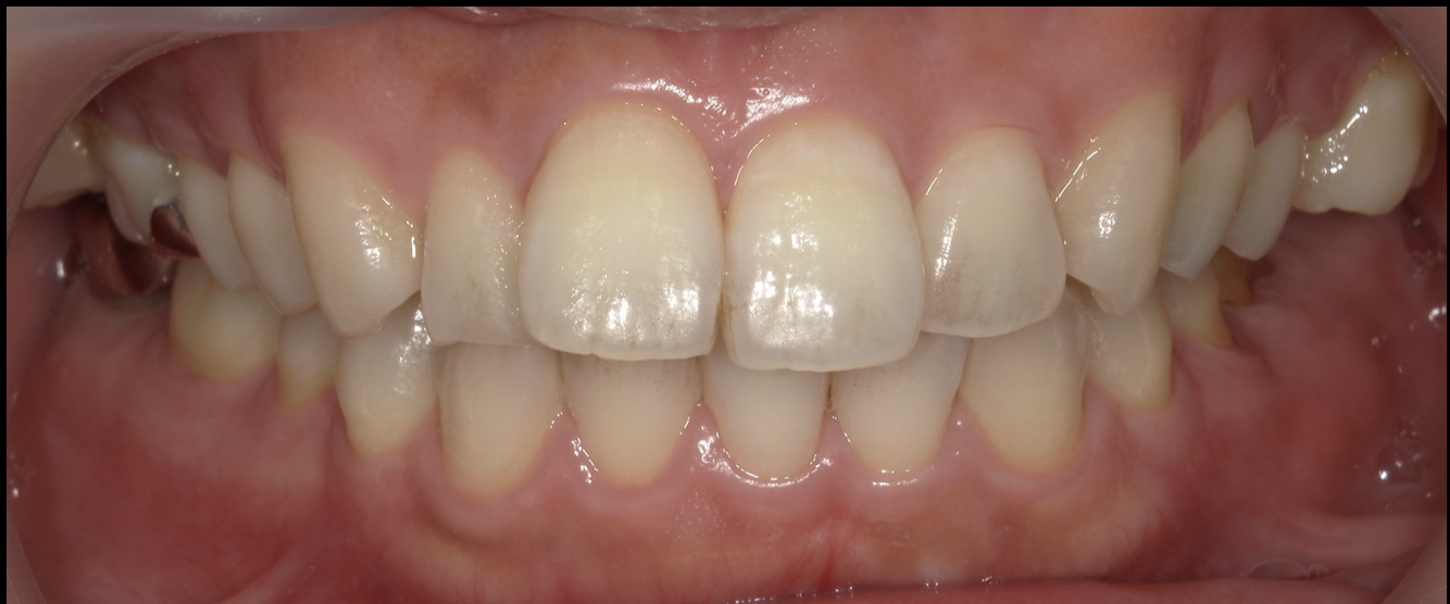 シザーズバイトをアンカースクリューを用いた矯正で改善した症例