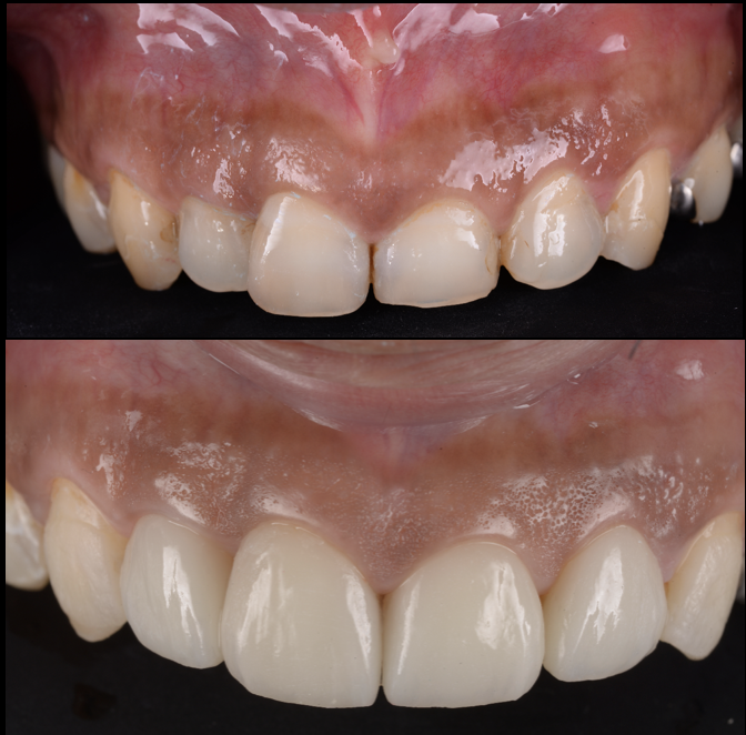 前歯の形が変になってきた