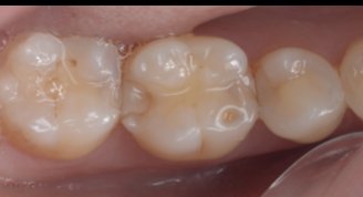 詰め物が劣化した