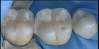 詰め物が劣化した