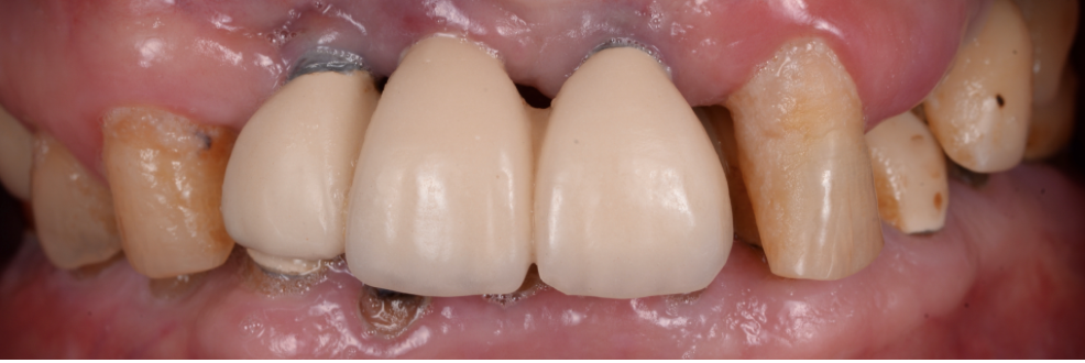 すでに入っているインプラントと追加埋入および補綴治療で審美的機能的に回復させた症例