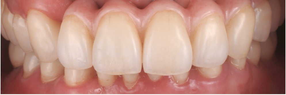 すでに入っているインプラントと追加埋入および補綴治療で審美的機能的に回復させた症例