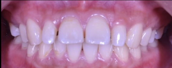 歯の隙間と前歯を引っ込めたい