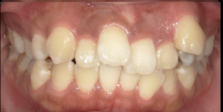 歯並びを何とかしたい