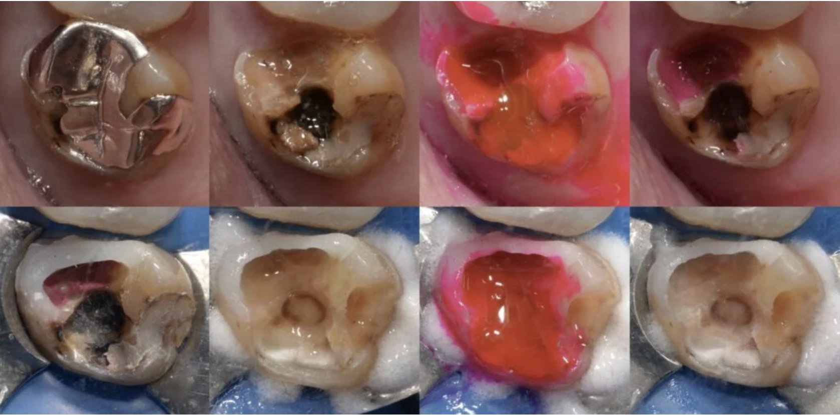 「う蝕検知液を使用して虫歯の感染歯質を確認している様子」