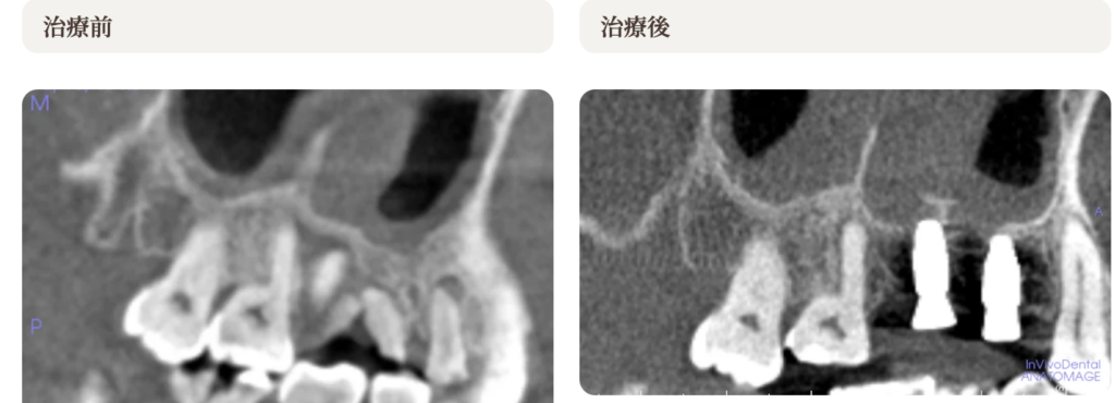 ソケットリフト術前術後のCT