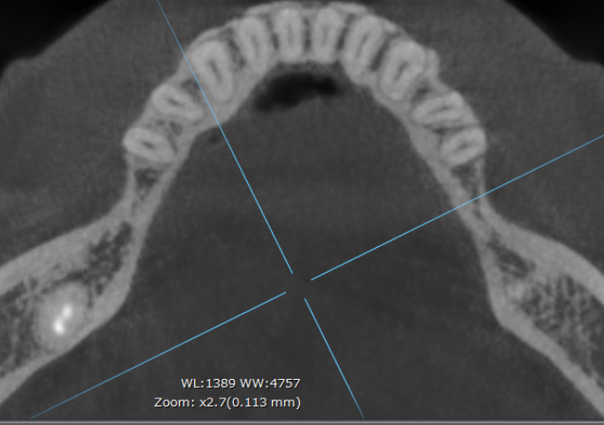 CTアキシャル像で確認するインプラント周囲の骨量(骨のバリアを意識した設計例)①