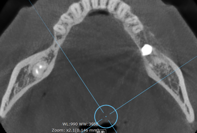 CTアキシャル像で確認するインプラント周囲の骨量（骨のバリアを意識した設計例）②