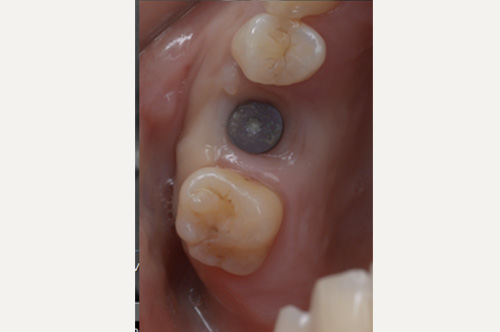 口腔内写真で確認するインプラント周囲の歯肉ボリューム(歯肉バリア:目安4mm)