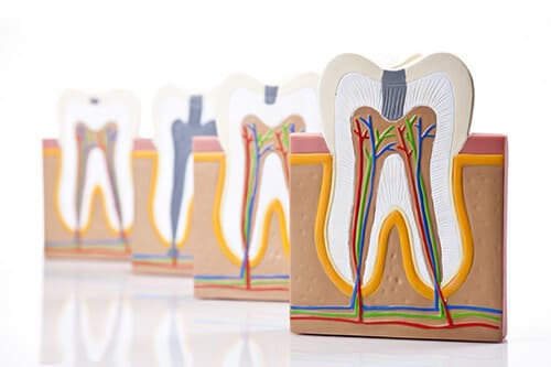 重度のむし歯でも歯を残すための根管治療