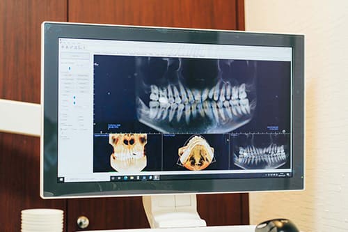 「デジタルレントゲン」や「CT」を使用した精確な診査診断