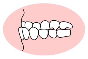 下顎前突(受け口) 