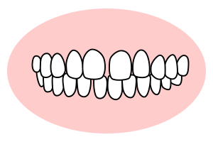 正中離開(空隙歯列、すきっ歯) 