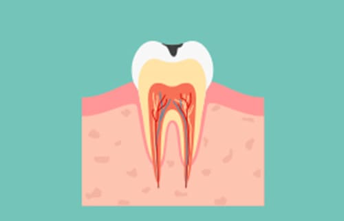 C1：エナメル質のむし歯