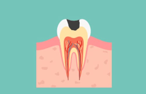 C2：象牙質のむし歯