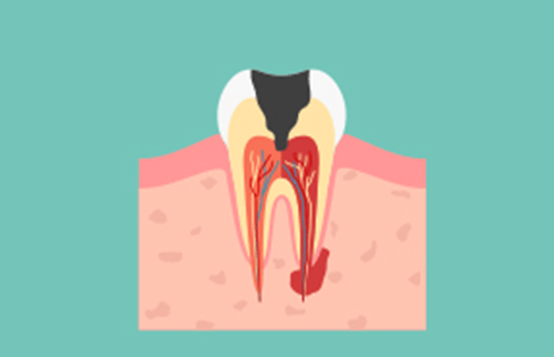 C4：歯根のむし歯