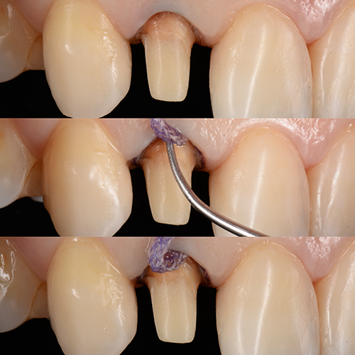２．歯と詰め物の間に隙間を残さないための徹底的な精密治療