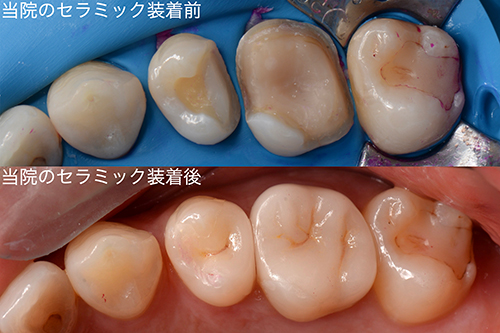 当院のセラミック事例
