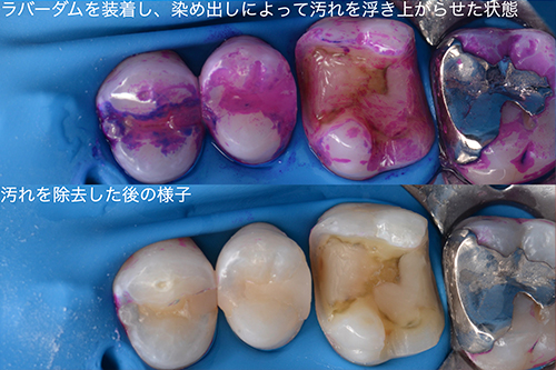 ４．装着前の丁寧なクリーニングと装着時の接着剤の使用