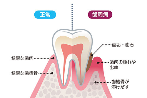 歯周病について