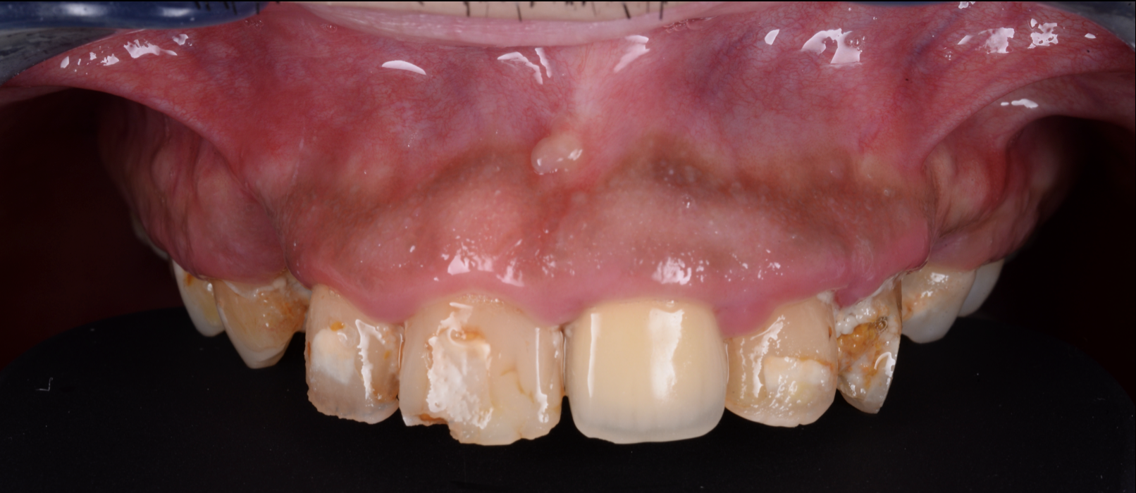 歯がボロボロでも、もう一度しっかり噛めて笑える口元へ｜池袋での総合治療症例