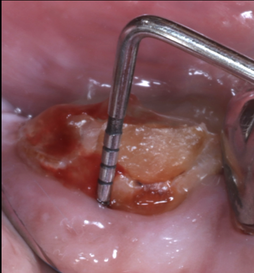 その歯、本当に抜かないといけませんか？｜精密根管治療×歯周再生×咬合管理で予後を改善