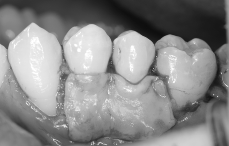 【池袋｜歯肉退縮の治療】結合組織移植術によるルートカバレッジで健康的で美しい歯ぐき