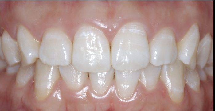 ホワイトニングのご紹介