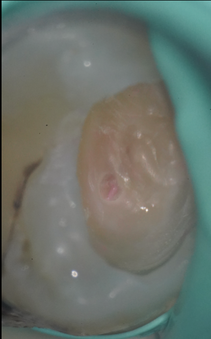 池袋で丁寧な虫歯治療を