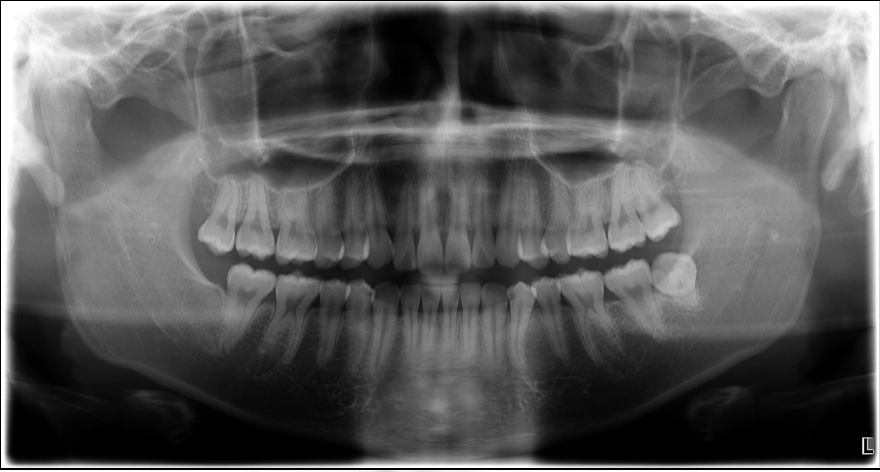 【池袋・親知らず抜歯】