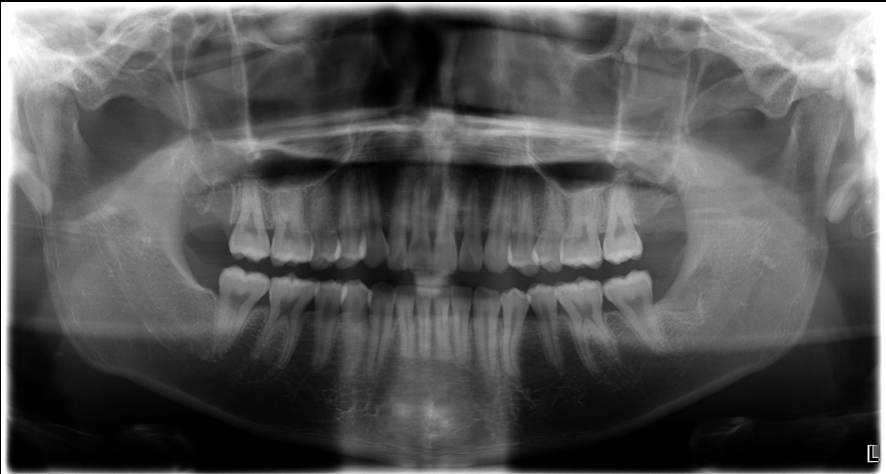 【池袋・親知らず抜歯】