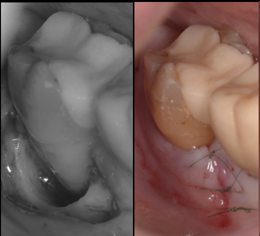 【池袋 歯周病専門治療】奥歯の歯ぐきの違和感、放置していませんか？