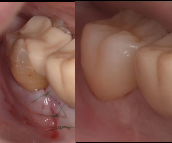 【池袋 歯周病専門治療】奥歯の歯ぐきの違和感、放置していませんか？