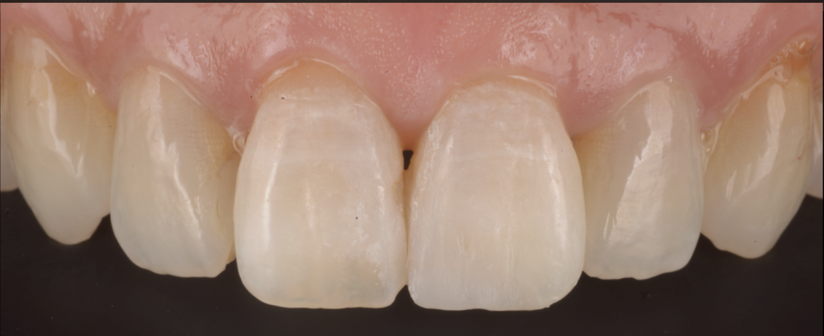 [池袋で丁寧な虫歯治療]小さな虫歯だからこそ、歯の寿命を延ばす精密治療を
