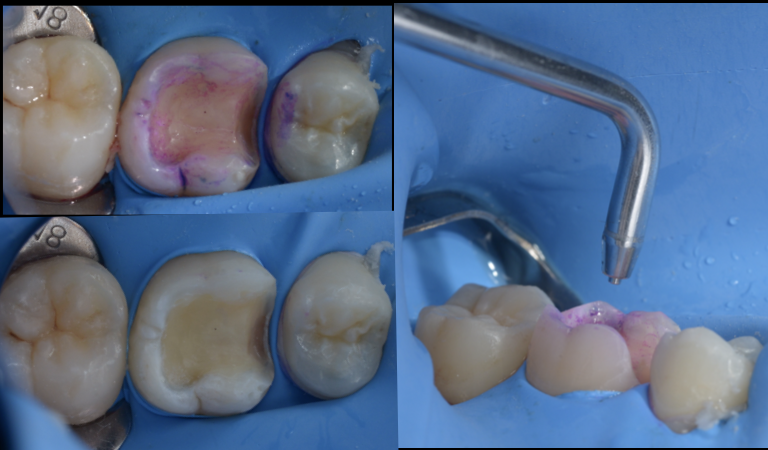 セラミック治療で後悔しないために。歯科医院選びの重要な“セットのこだわり”とは？
