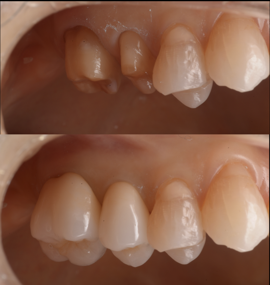 【池袋】クラウン・被せ物治療で後悔しないために大切なこと