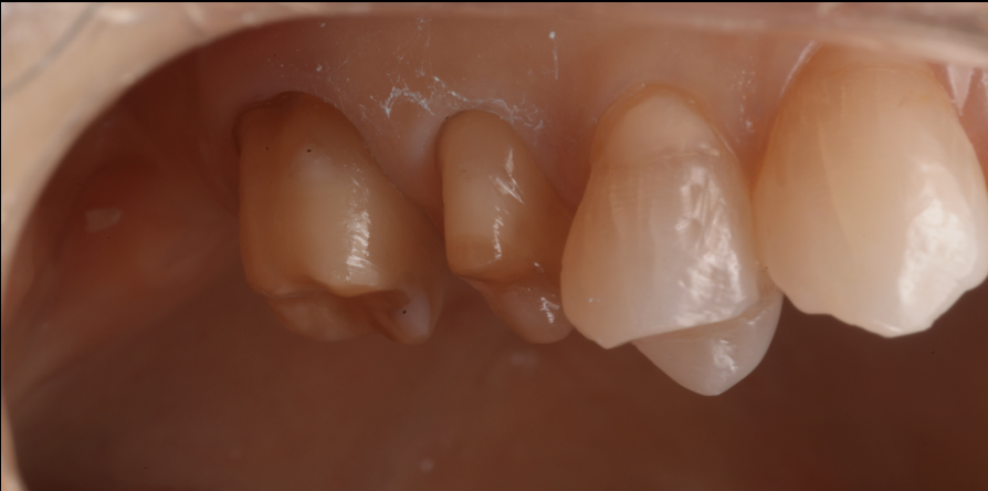 【池袋】クラウン・被せ物治療で後悔しないために大切なこと